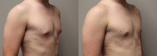 male breast reduction before and after photos by kryger institute of plastic surgery in thousand oaks ca