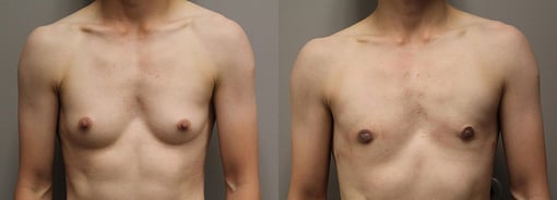male breast reduction before and after photos by kryger institute of plastic surgery in thousand oaks ca