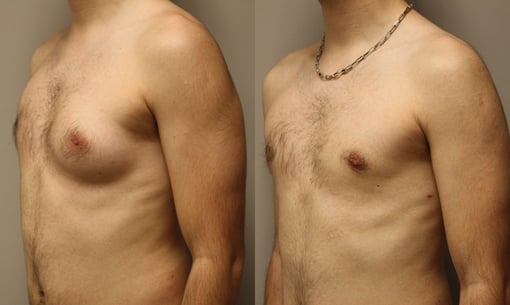 male breast reduction before and after photos by kryger institute of plastic surgery in thousand oaks ca