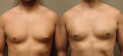 male breast reduction before and after photos by kryger institute of plastic surgery in thousand oaks ca