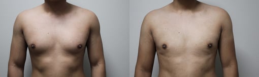 male breast reduction before and after photos by kryger institute of plastic surgery in thousand oaks ca