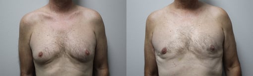 male breast reduction before and after photos by kryger institute of plastic surgery in thousand oaks ca