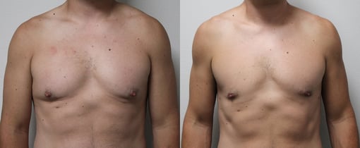 male breast reduction before and after photos by kryger institute of plastic surgery in thousand oaks ca