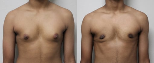 male breast reduction before and after photos by kryger institute of plastic surgery in thousand oaks ca