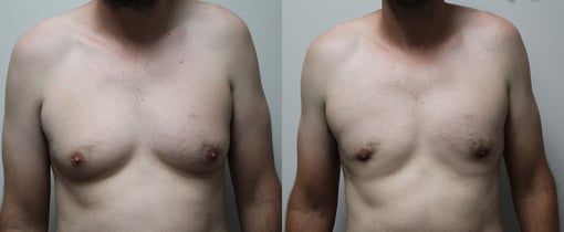 male breast reduction before and after photos by kryger institute of plastic surgery in thousand oaks ca