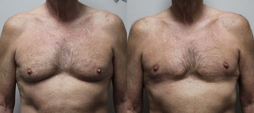 male breast reduction before and after photos by kryger institute of plastic surgery in thousand oaks ca
