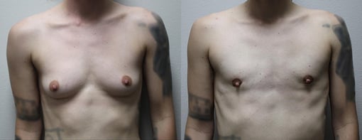 male breast reduction before and after photos by kryger institute of plastic surgery in thousand oaks ca