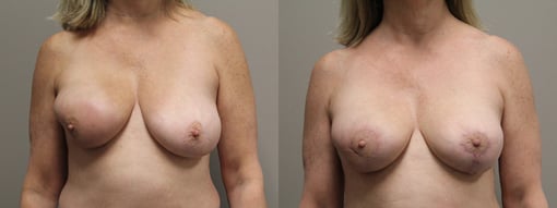 lumpectomy defect reconstruction before and after photos by kryger institute of plastic surgery in thousand oaks ca