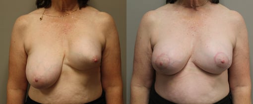 lumpectomy defect reconstruction before and after photos by kryger institute of plastic surgery in thousand oaks ca