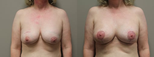 lumpectomy defect reconstruction before and after photos by kryger institute of plastic surgery in thousand oaks ca