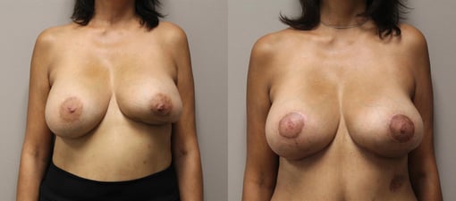 lumpectomy defect reconstruction before and after photos by kryger institute of plastic surgery in thousand oaks ca