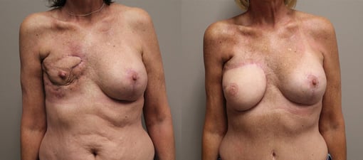 lumpectomy defect reconstruction before and after photos by kryger institute of plastic surgery in thousand oaks ca