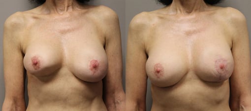 lumpectomy defect reconstruction before and after photos by kryger institute of plastic surgery in thousand oaks ca