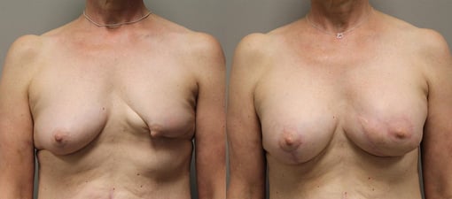 lumpectomy defect reconstruction before and after photos by kryger institute of plastic surgery in thousand oaks ca