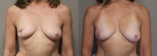 lumpectomy defect reconstruction before and after photos by kryger institute of plastic surgery in thousand oaks ca