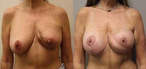 lumpectomy defect reconstruction before and after photos by kryger institute of plastic surgery in thousand oaks ca