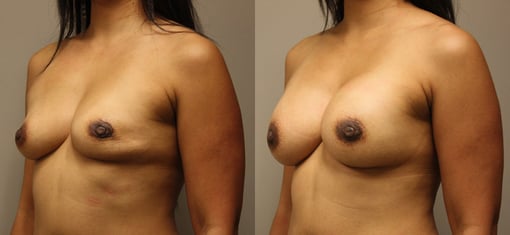 lumpectomy defect reconstruction before and after photos by kryger institute of plastic surgery in thousand oaks ca