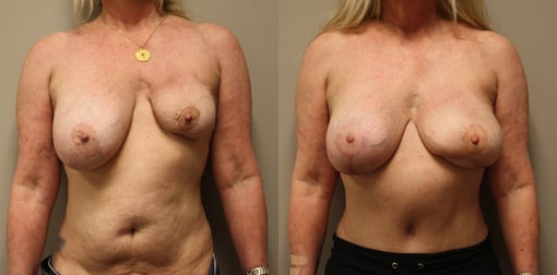 lumpectomy defect reconstruction before and after photos by kryger institute of plastic surgery in thousand oaks ca