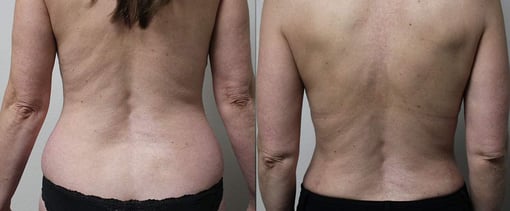 liposuction before and after photos by kryger institute of plastic surgery in thousand oaks ca