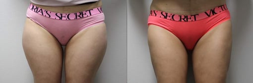 liposuction before and after photos by kryger institute of plastic surgery in thousand oaks ca