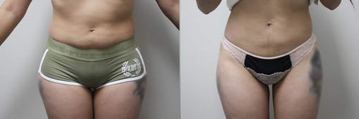 liposuction before and after photos by kryger institute of plastic surgery in thousand oaks ca