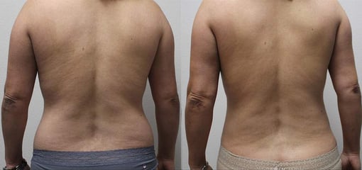 liposuction before and after photos by kryger institute of plastic surgery in thousand oaks ca