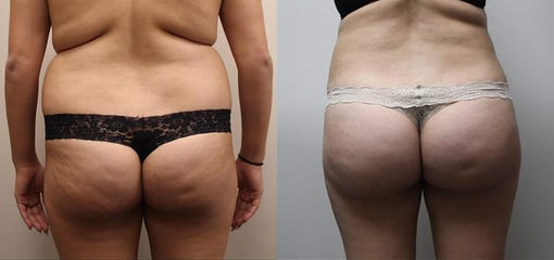 liposuction before and after photos by kryger institute of plastic surgery in thousand oaks ca