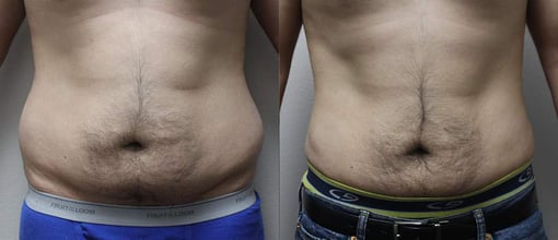 liposuction before and after photos by kryger institute of plastic surgery in thousand oaks ca