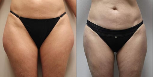 liposuction before and after photos by kryger institute of plastic surgery in thousand oaks ca