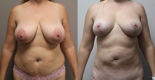 liposuction before and after photos by kryger institute of plastic surgery in thousand oaks ca