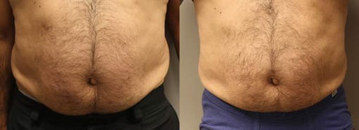 liposuction before and after photos by kryger institute of plastic surgery in thousand oaks ca