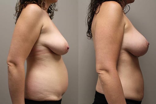 liposuction before and after photos by kryger institute of plastic surgery in thousand oaks ca
