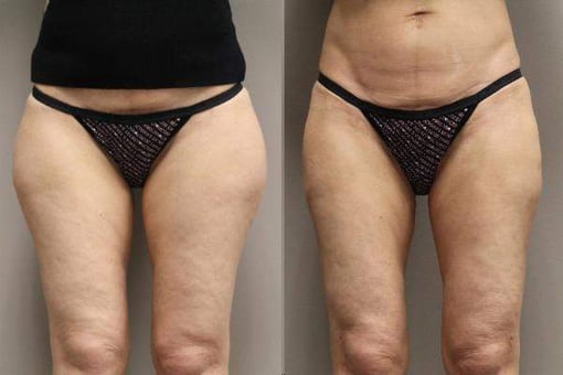 liposuction before and after photos by kryger institute of plastic surgery in thousand oaks ca