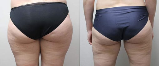 liposuction before and after photos by kryger institute of plastic surgery in thousand oaks ca
