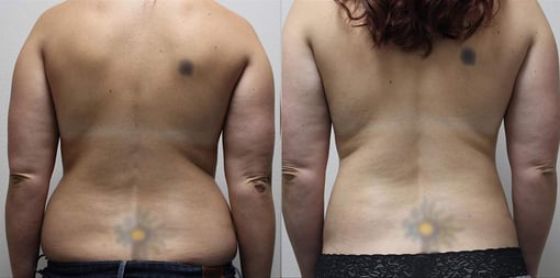 liposuction before and after photos by kryger institute of plastic surgery in thousand oaks ca