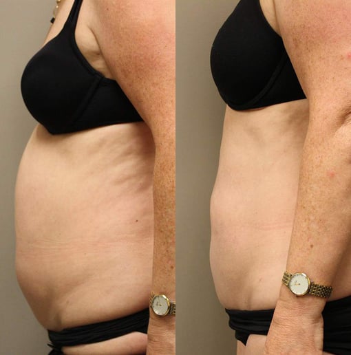 liposuction before and after photos by kryger institute of plastic surgery in thousand oaks ca