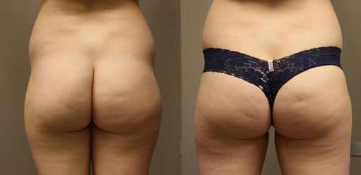 liposuction before and after photos by kryger institute of plastic surgery in thousand oaks ca