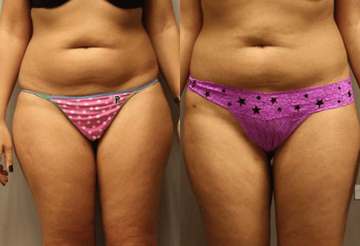 liposuction before and after photos by kryger institute of plastic surgery in thousand oaks ca