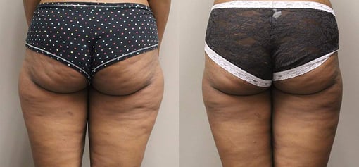 liposuction before and after photos by kryger institute of plastic surgery in thousand oaks ca