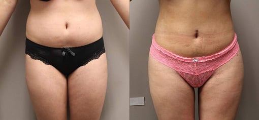 liposuction before and after photos by kryger institute of plastic surgery in thousand oaks ca
