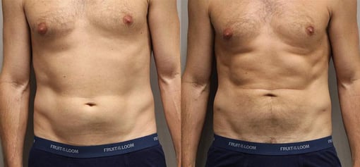 liposuction before and after photos by kryger institute of plastic surgery in thousand oaks ca