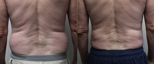 liposuction before and after photos by kryger institute of plastic surgery in thousand oaks ca