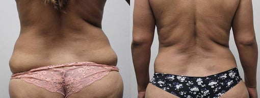 liposuction before and after photos by kryger institute of plastic surgery in thousand oaks ca