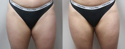liposuction before and after photos by kryger institute of plastic surgery in thousand oaks ca