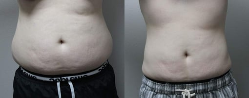 liposuction before and after photos by kryger institute of plastic surgery in thousand oaks ca