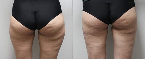 liposuction before and after photos by kryger institute of plastic surgery in thousand oaks ca