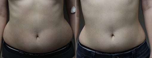 liposuction before and after photos by kryger institute of plastic surgery in thousand oaks ca