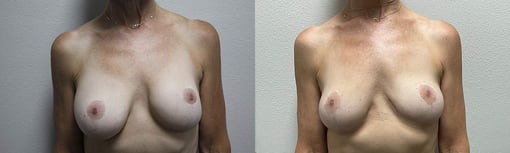 implant removal before and after photos by kryger institute of plastic surgery in thousand oaks ca