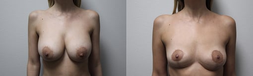 implant removal before and after photos by kryger institute of plastic surgery in thousand oaks ca