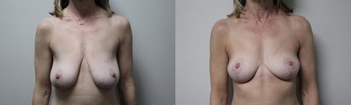 implant removal before and after photos by kryger institute of plastic surgery in thousand oaks ca